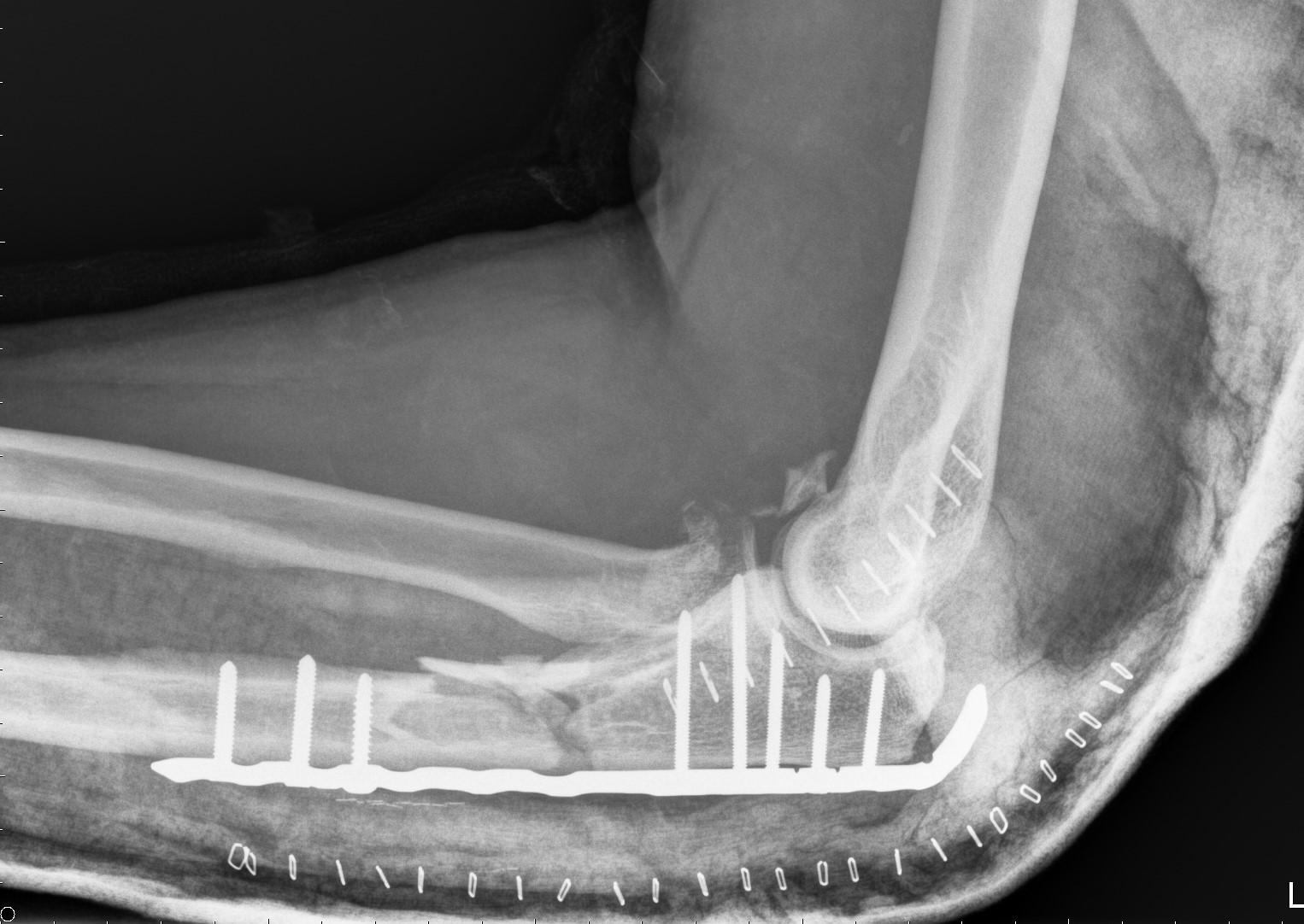 monteggia-x-ray.jpg