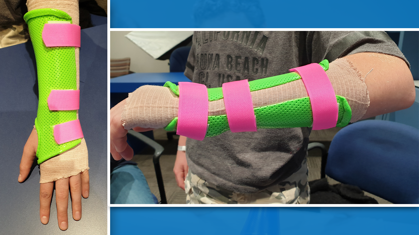 splint-images.png