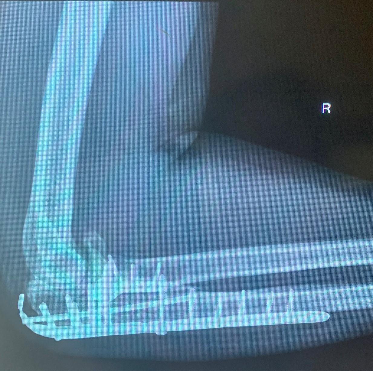 turnbuckle-2.jpg