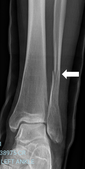 mc-fibula.png