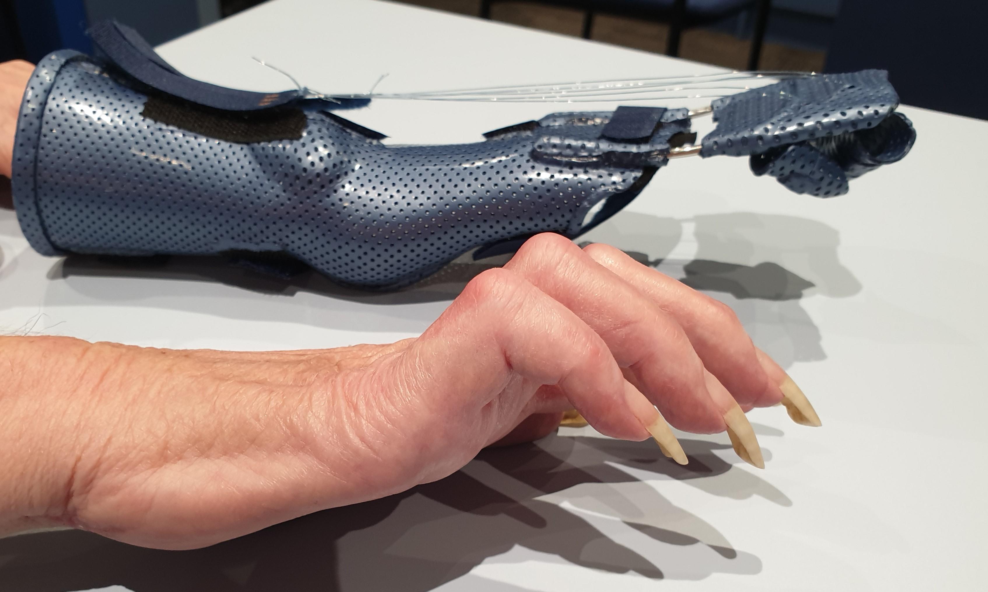 ulnar-claw-1.jpg