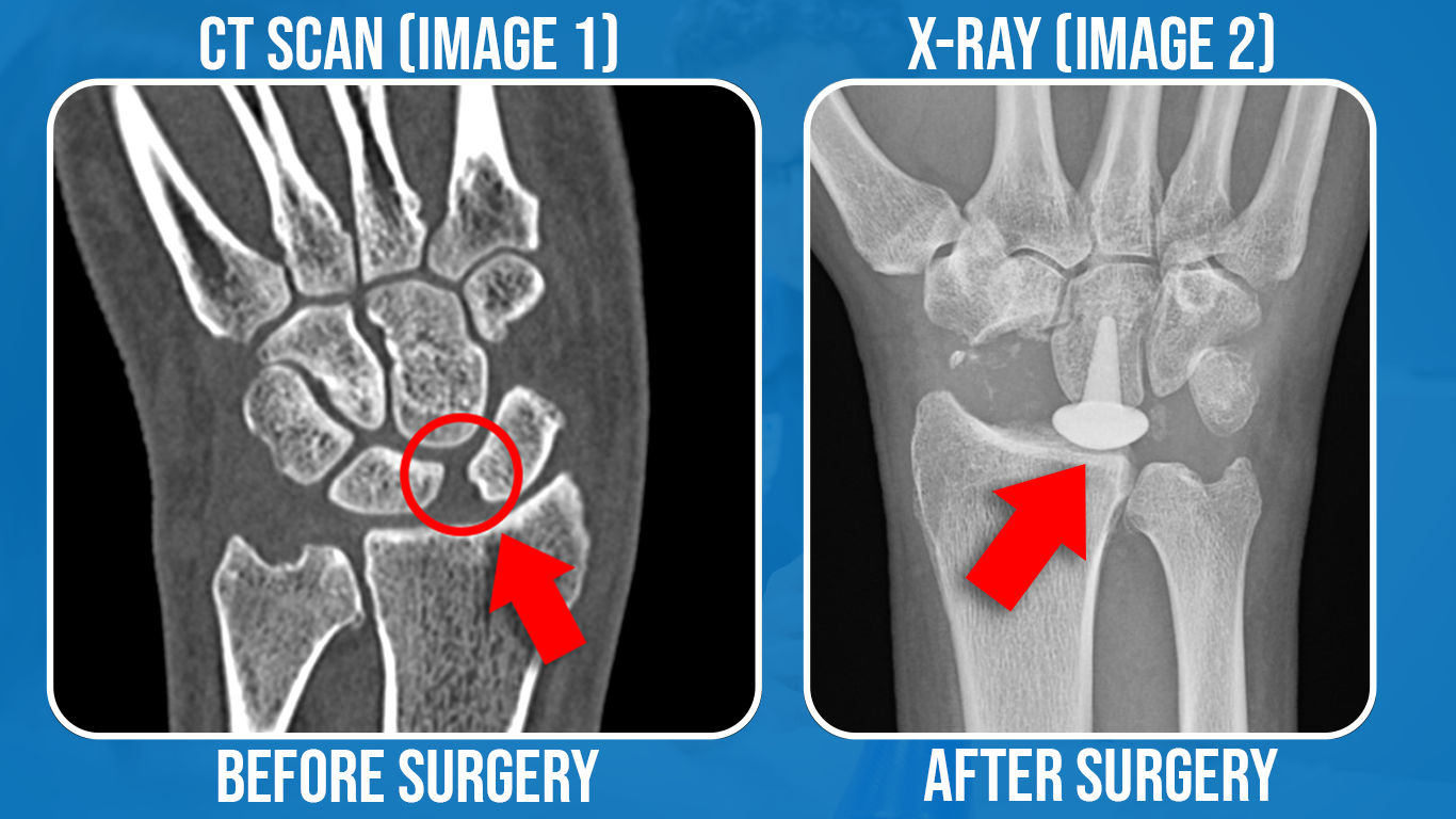 wrist-instability-image-1-and-2.png